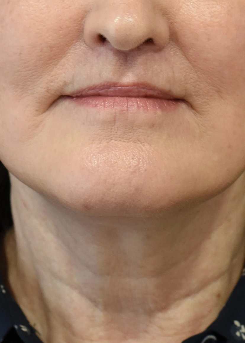 Deep Plane Facelift Patient 36 Set 1 After
